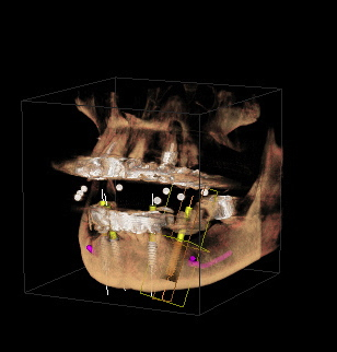 3D-Diagnostik Beispiel | Zahnarzt im Arnulfpark
