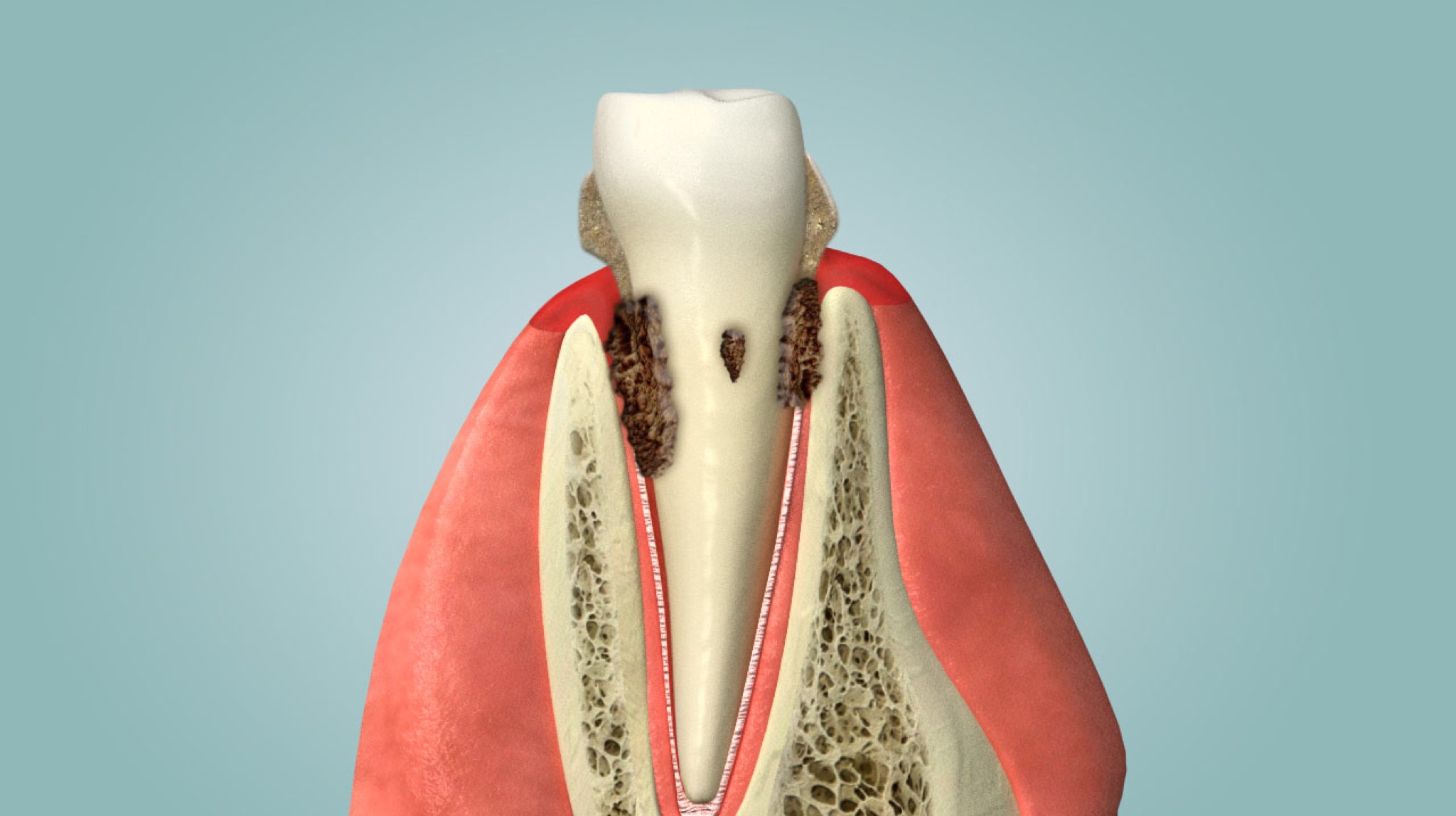 Vorsorge und Behandlung Parodontose | Dr. Hausamen München