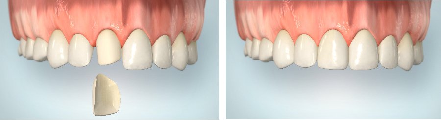 Behandlung der Zähne mit Veneers | Zahnarzt im Arnulfpark